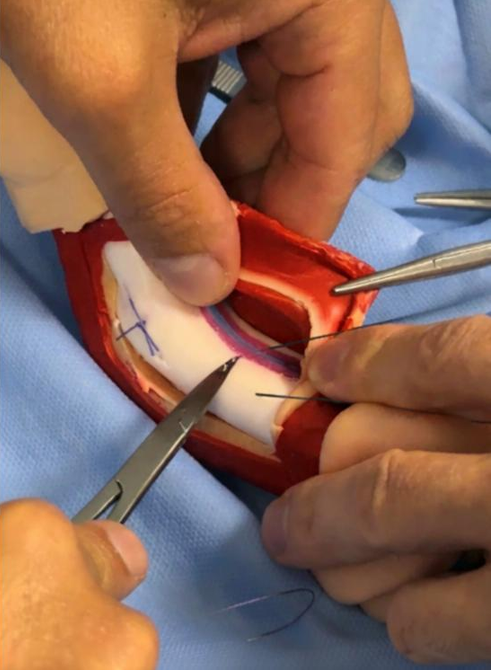 Peyronie's Disease Surgical Simulator - Image 2