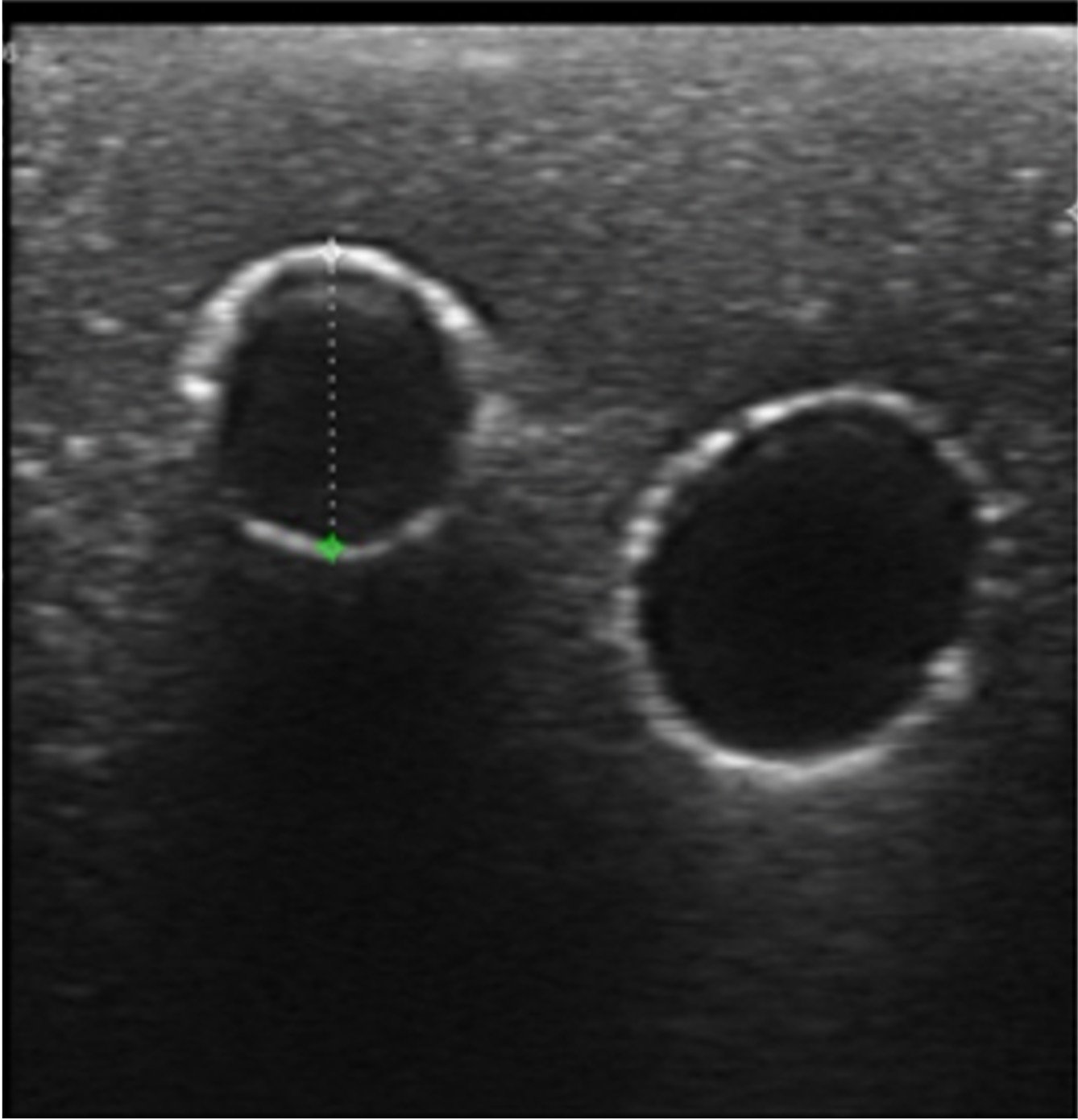 Ultrasound-Guided Femoral Vacsular Access - Image 3