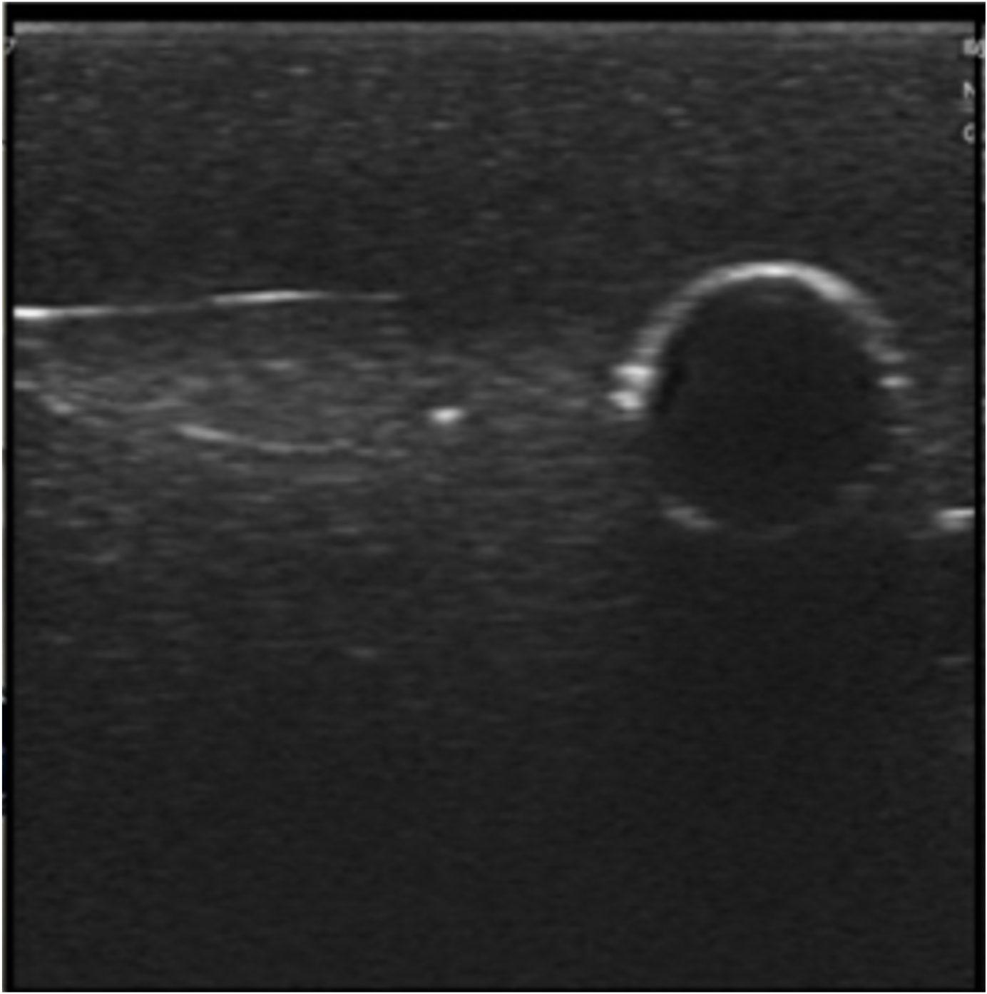 Ultrasound-Guided Femoral Vacsular Access - Image 4